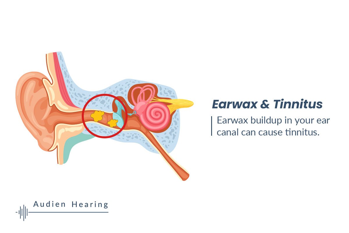 Earwax Buildup and Tinnitus